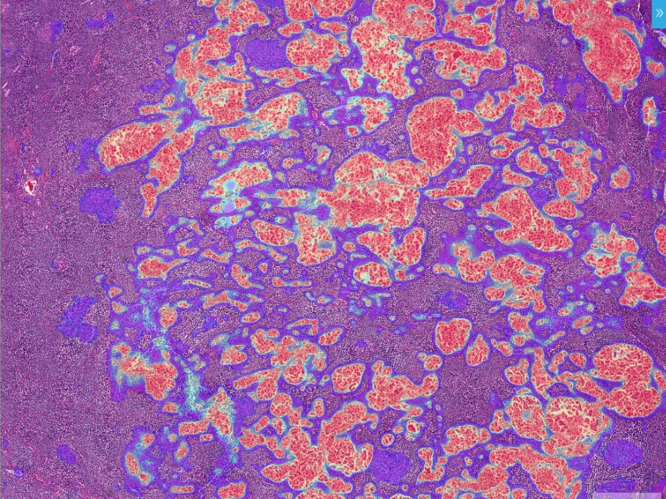 Pan-Cancer Lymph Node Metastasis Assistant Analysis Modules